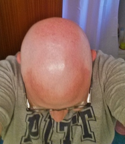 Top of head after shaving it. I am now fully bald.